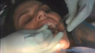 Dentist fetish. Girl gets full mouth of amalgam